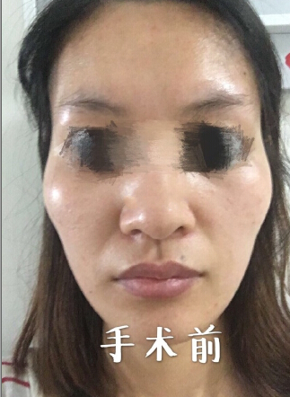 扬州第一人民医院冯有支做的多方面部脂肪填充