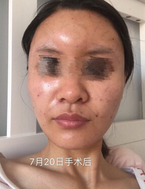 扬州第一人民医院冯有支做的多方面部脂肪填充