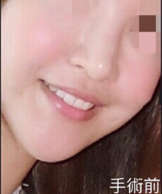 台湾许英哲医生做的全肋骨鼻修复和下巴注射物
