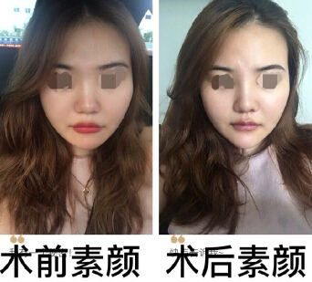 深圳西一诺整形医院做的鼻部手术和假体下巴