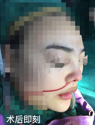深圳西一诺整形医院做的鼻部手术和假体下巴