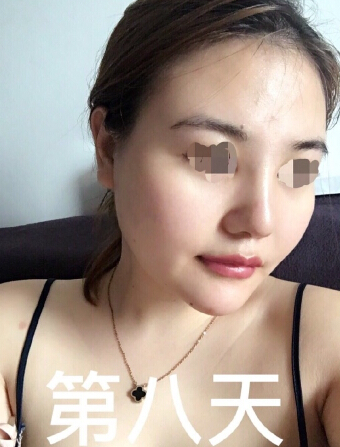 深圳西一诺整形医院做的鼻部手术和假体下巴