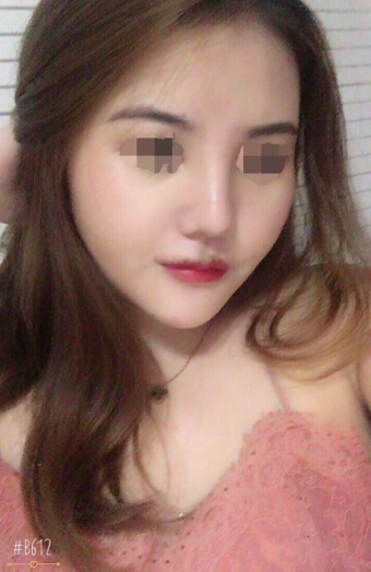 深圳西一诺整形医院做的鼻部手术和假体下巴