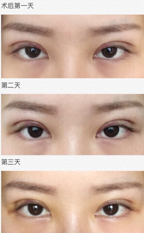 长沙美之峰丁翔副院长做的微创三点双眼皮