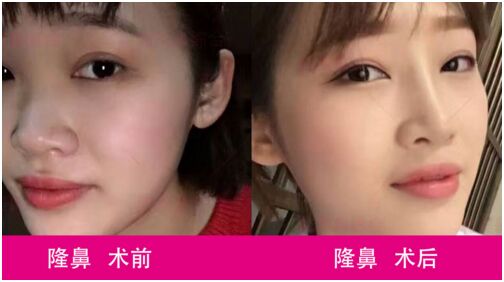 长沙雅美12周年庆--眼鼻特价活动