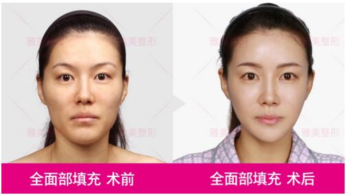 长沙雅美12周年庆--眼鼻特价活动