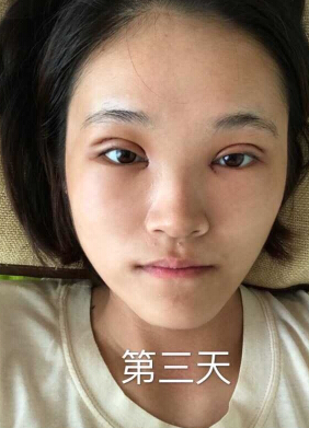 合肥华美赵院长做的韩式+开眼角