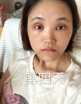 合肥华美赵院长做的韩式+开眼角