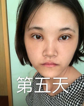 合肥华美赵院长做的韩式+开眼角