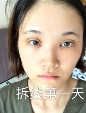 合肥华美赵院长做的韩式+开眼角