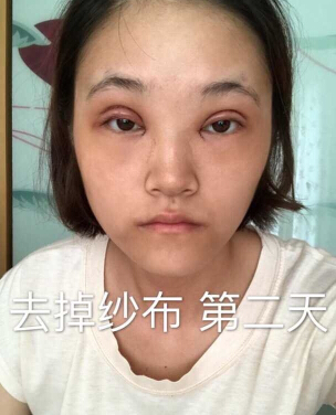 合肥华美赵院长做的韩式+开眼角