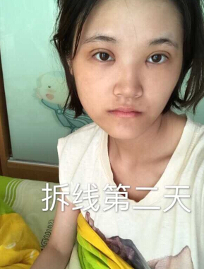 合肥华美赵院长做的韩式+开眼角
