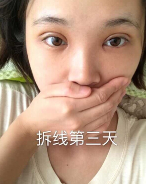 合肥华美赵院长做的韩式+开眼角