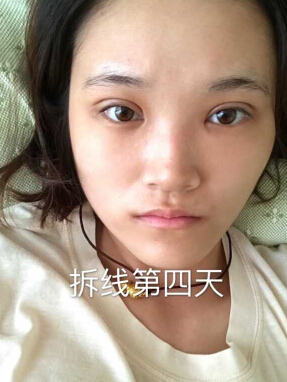 合肥华美赵院长做的韩式+开眼角
