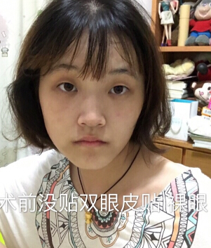 合肥华美赵院长做的韩式+开眼角