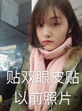 合肥华美赵院长做的韩式+开眼角