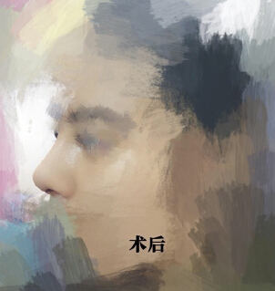 北京八大处赵穆欣做的鼻部手术