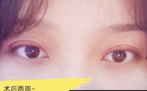 徐州医科大学附属医院张爱君医生做的双眼皮