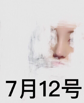 郑州美莱医疗美容医院周文做的鼻部手术整形