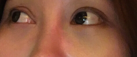 激光、脱毛、水光补水反馈一例