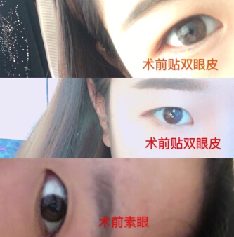 石家庄省二院张卓男医生做的全切双眼皮