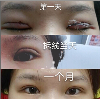 6.28号在九院李圣利医生处做的全切双眼皮