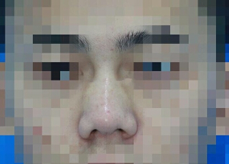 深圳艾妍徐荣阳做的鼻部手术和玻尿酸填充