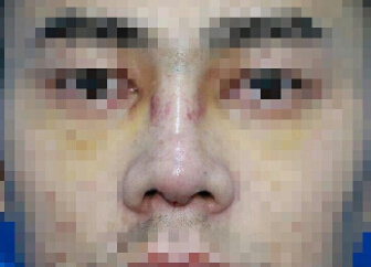 深圳艾妍徐荣阳做的鼻部手术和玻尿酸填充