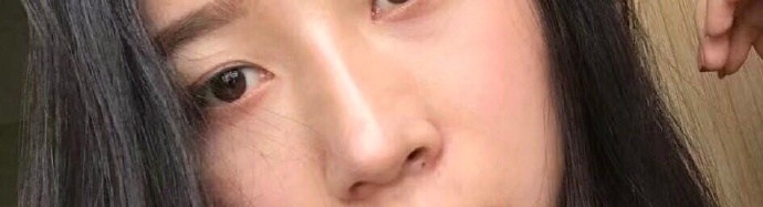 昆明梦想整形做的隆鼻、垫鼻尖,缩小鼻翼