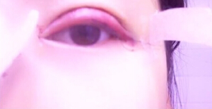 上海洁铭医疗美容门诊陈超群做的眼部手术