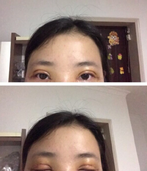 上海洁铭医疗美容门诊陈超群做的眼部手术