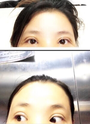 上海洁铭医疗美容门诊陈超群做的眼部手术
