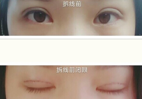 长沙爱思特整形医院杨千里做的全切双眼皮