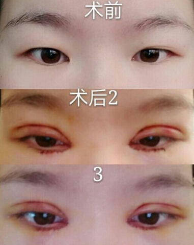 武汉美丽尔整形张琦医生做的双眼皮+开眼角