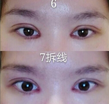 武汉美丽尔整形张琦医生做的双眼皮+开眼角