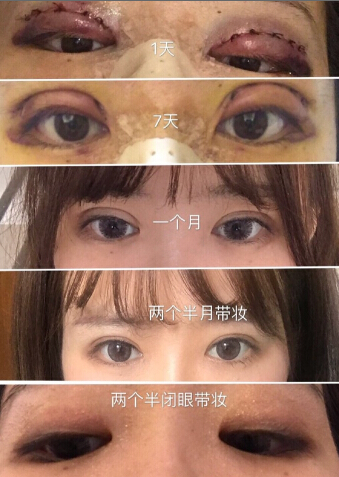 重庆张劲博士处做的鼻眼部手术整形手术