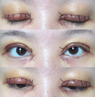 罗敏医生手术,双眼皮,去皮去脂,开眼角