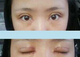石家庄蓝山王院长做的全切去皮去脂开眼角