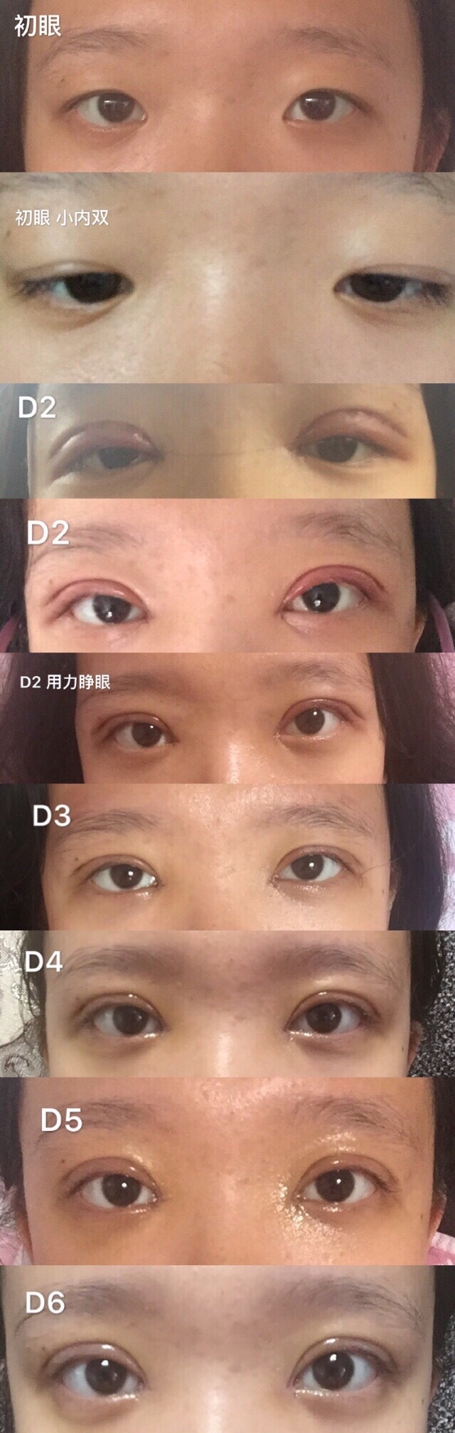 北京同仁医院孙强做的双眼皮,内眼角