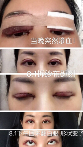 重庆时光整形陈玉连做的双眼皮提肌+开眼角