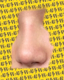 我的鼻子是不是做失败了呀?