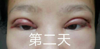 临沂中医院胡秀启主处做的眼部手术整形手术