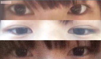修复的时候需要顺便开眼角吗?