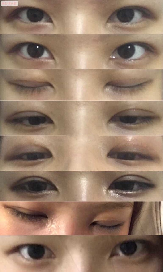 修复的时候需要顺便开眼角吗?