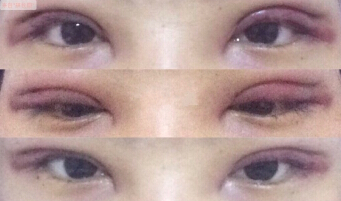 修复的时候需要顺便开眼角吗?