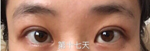 南京妇幼保健院高艳丽医生做双眼皮手术