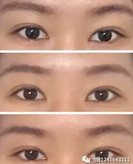 在黑龙江一个公立三甲医院做的双眼皮、内眼角