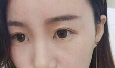达美整形邢文明做的全切双眼皮+开内眼角