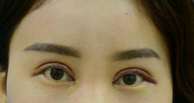 达美整形邢文明做的全切双眼皮+开内眼角