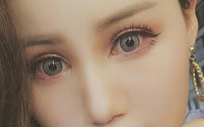 达美整形邢文明做的全切双眼皮+开内眼角